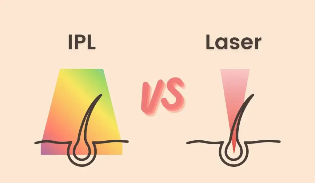 Brazilianwaxalmereangelssecret.nl - IPL VS Laser